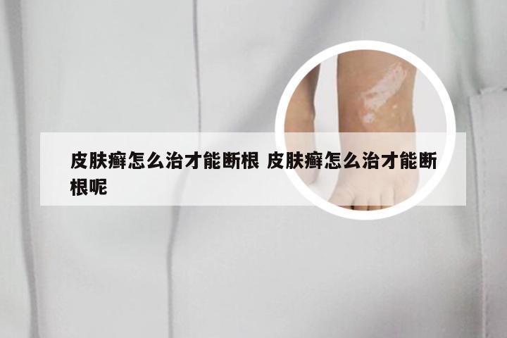 皮肤癣怎么治才能断根 皮肤癣怎么治才能断根呢