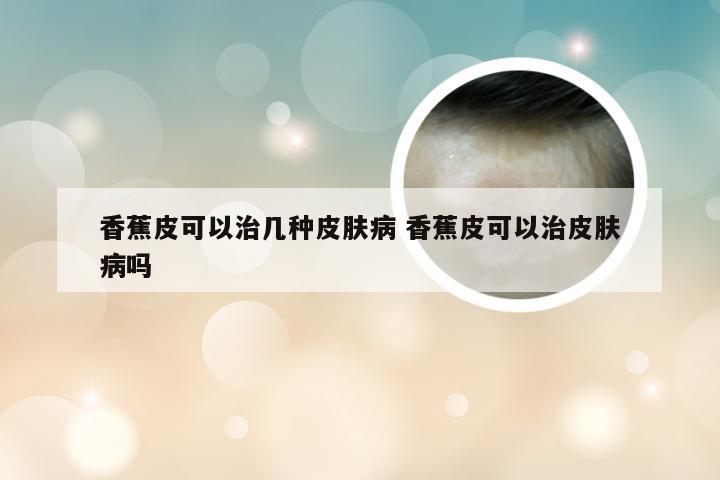 香蕉皮可以治几种皮肤病 香蕉皮可以治皮肤病吗