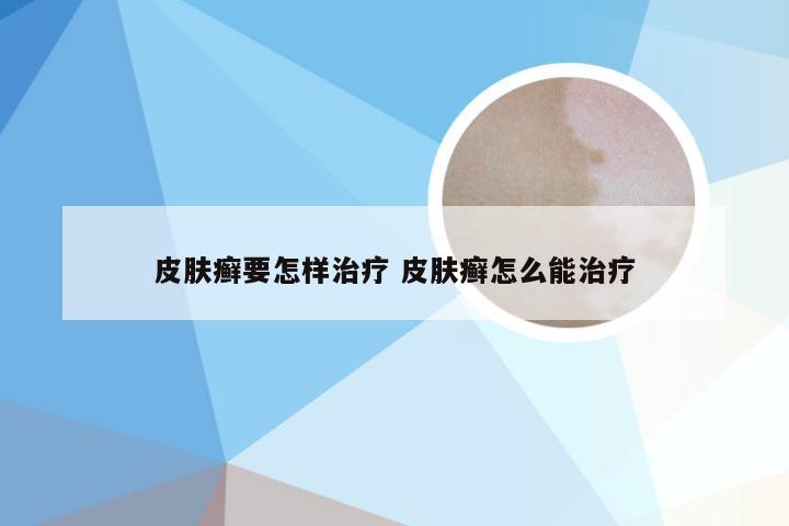 皮肤癣要怎样治疗 皮肤癣怎么能治疗