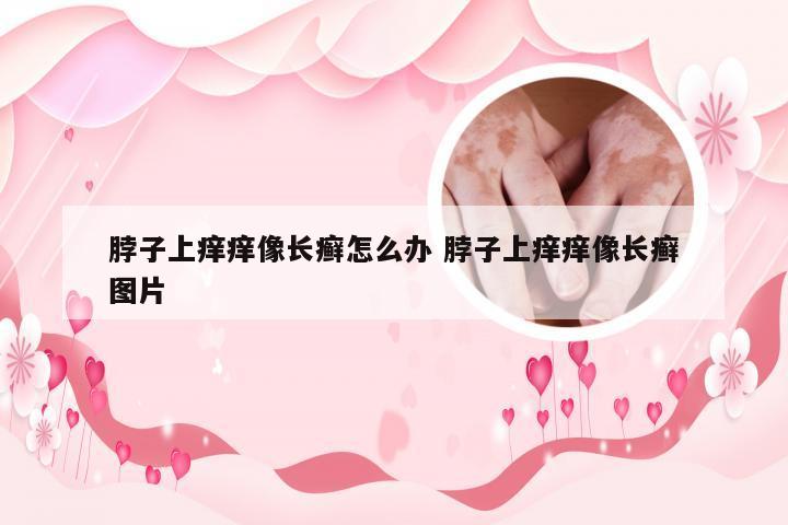 脖子上痒痒像长癣怎么办 脖子上痒痒像长癣图片