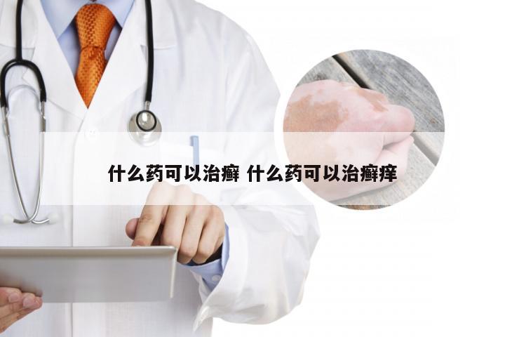 什么药可以治癣 什么药可以治癣痒