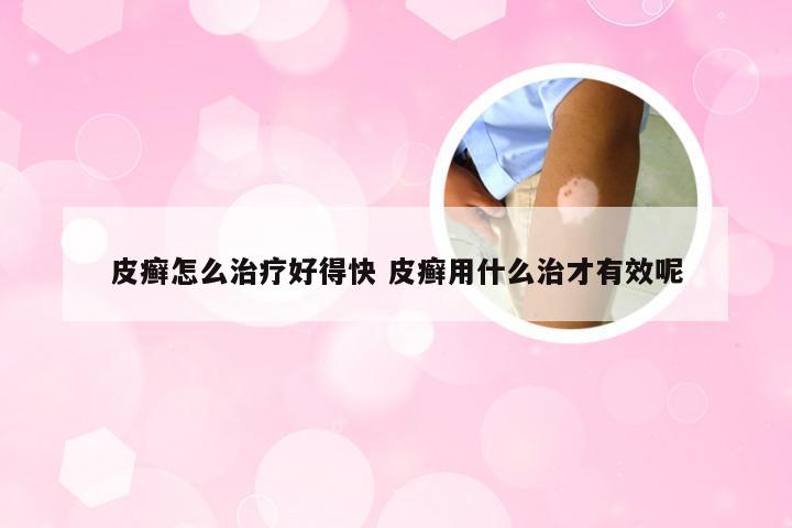 皮癣怎么治疗好得快 皮癣用什么治才有效呢
