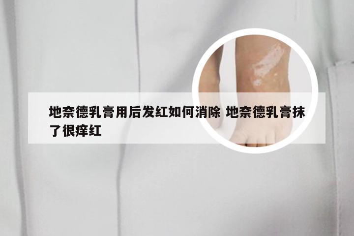 地奈德乳膏用后发红如何消除 地奈德乳膏抹了很痒红
