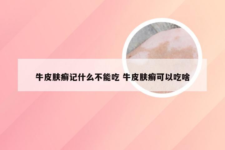 牛皮肤癣记什么不能吃 牛皮肤癣可以吃啥