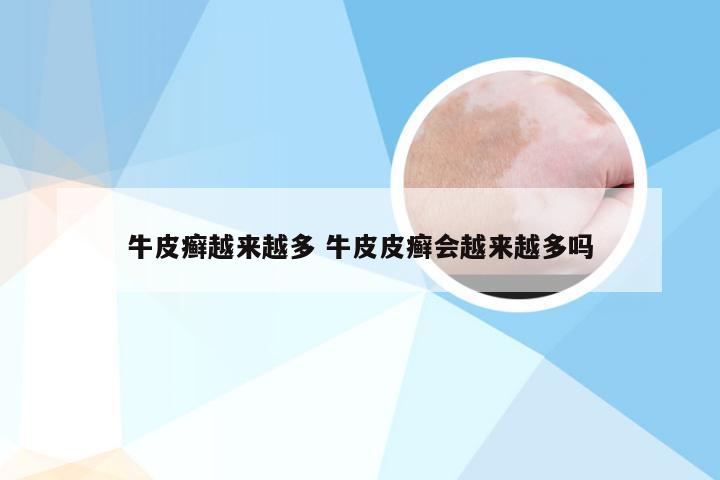 牛皮癣越来越多 牛皮皮癣会越来越多吗