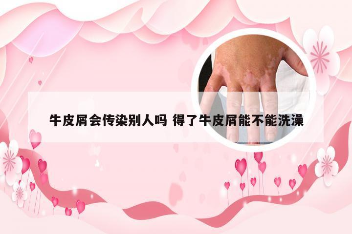 牛皮屑会传染别人吗 得了牛皮屑能不能洗澡
