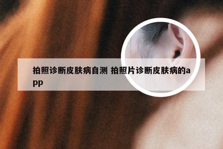 拍照诊断皮肤病自测 拍照片诊断皮肤病的app