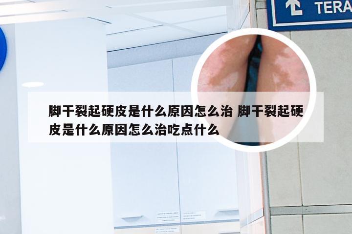 脚干裂起硬皮是什么原因怎么治 脚干裂起硬皮是什么原因怎么治吃点什么