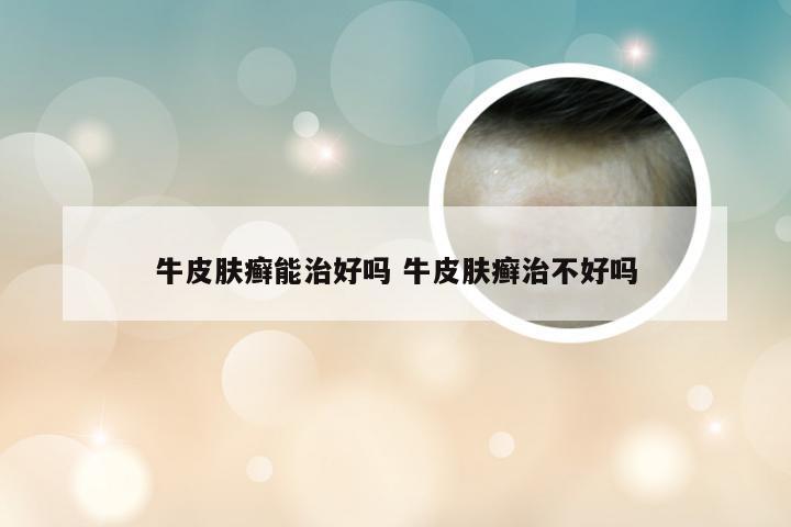 牛皮肤癣能治好吗 牛皮肤癣治不好吗