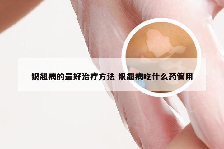 银翘病的最好治疗方法 银翘病吃什么药管用