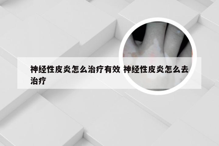 神经性皮炎怎么治疗有效 神经性皮炎怎么去治疗