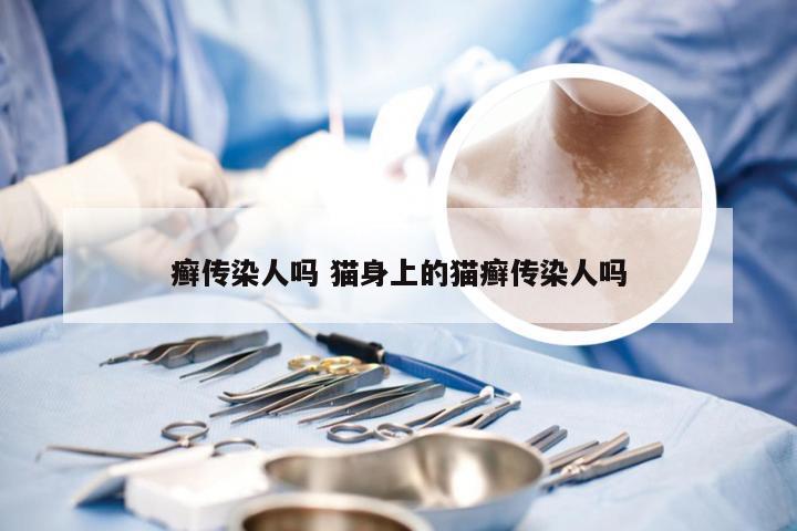 癣传染人吗 猫身上的猫癣传染人吗