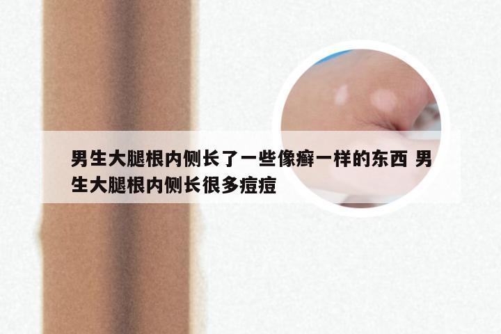 男生大腿根内侧长了一些像癣一样的东西 男生大腿根内侧长很多痘痘