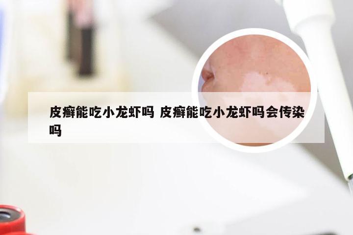 皮癣能吃小龙虾吗 皮癣能吃小龙虾吗会传染吗