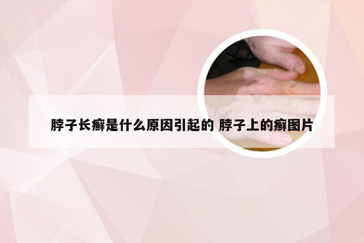 脖子长癣是什么原因引起的 脖子上的癣图片