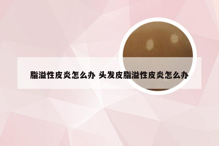 脂溢性皮炎怎么办 头发皮脂溢性皮炎怎么办