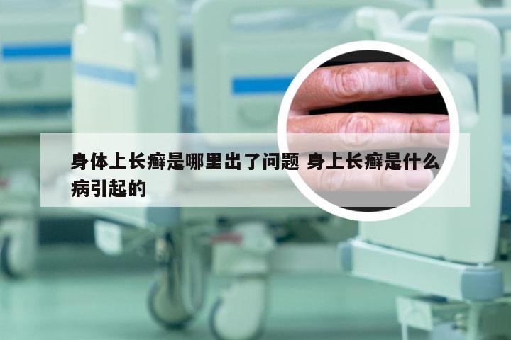 身体上长癣是哪里出了问题 身上长癣是什么病引起的