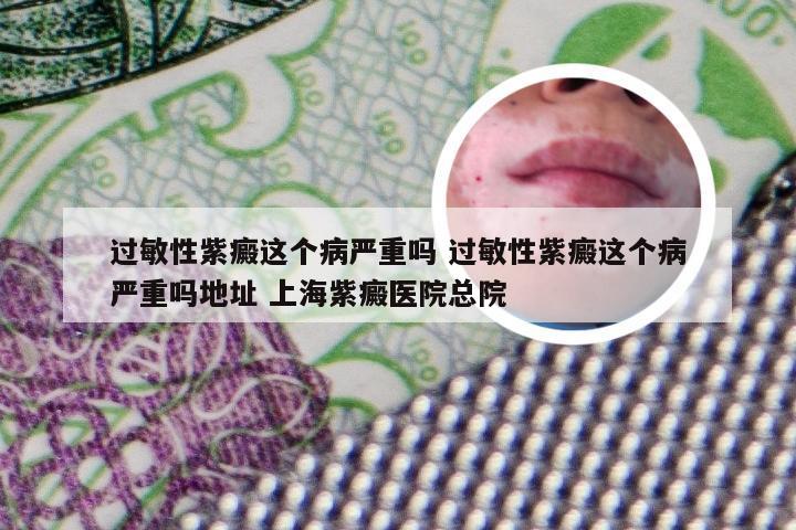 过敏性紫癜这个病严重吗 过敏性紫癜这个病严重吗地址 上海紫癜医院总院