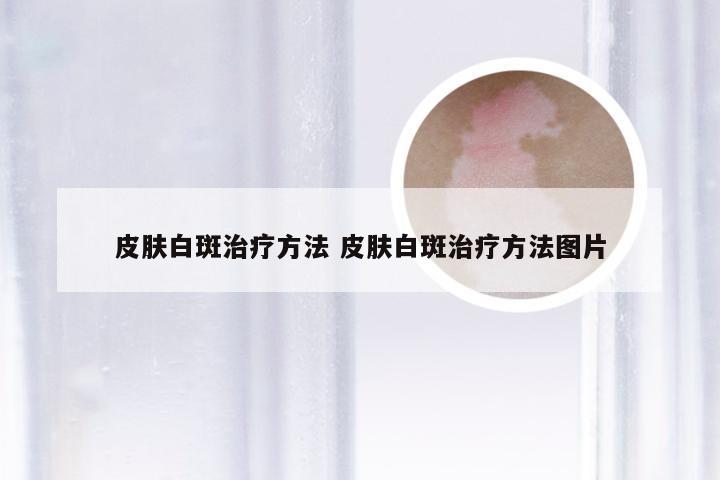 皮肤白斑治疗方法 皮肤白斑治疗方法图片