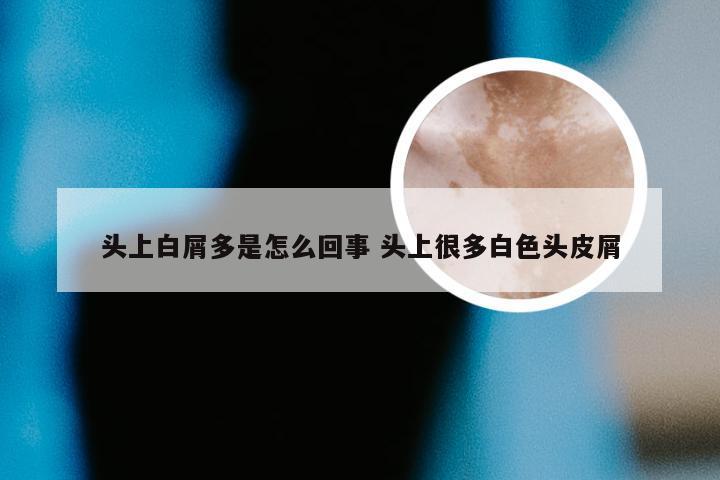 头上白屑多是怎么回事 头上很多白色头皮屑