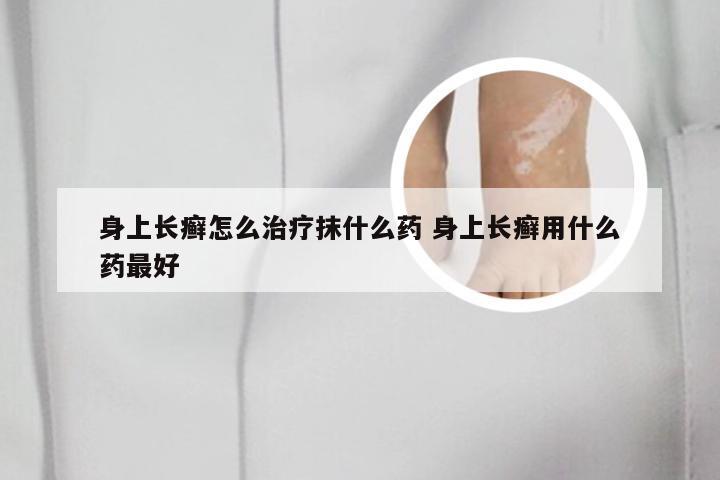 身上长癣怎么治疗抹什么药 身上长癣用什么药最好