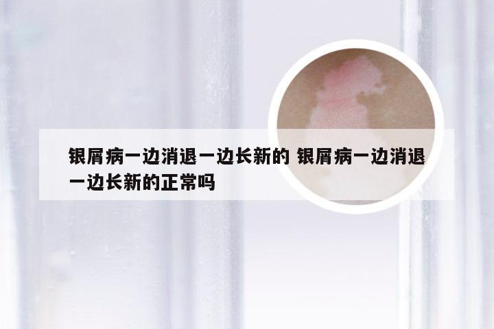 银屑病一边消退一边长新的 银屑病一边消退一边长新的正常吗