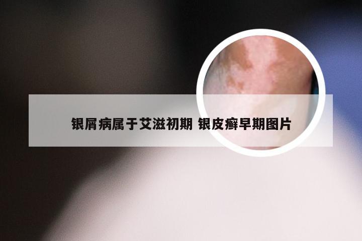 银屑病属于艾滋初期 银皮癣早期图片