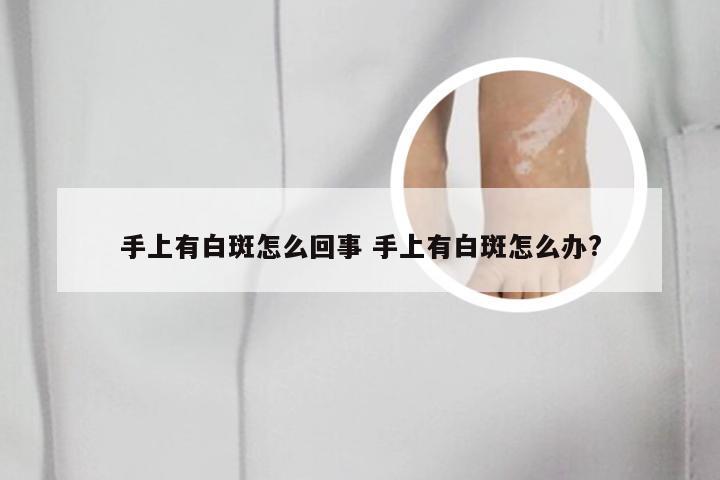 手上有白斑怎么回事 手上有白斑怎么办?