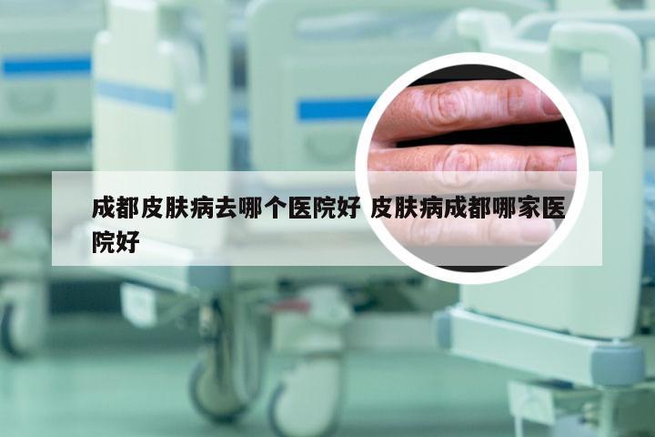 成都皮肤病去哪个医院好 皮肤病成都哪家医院好