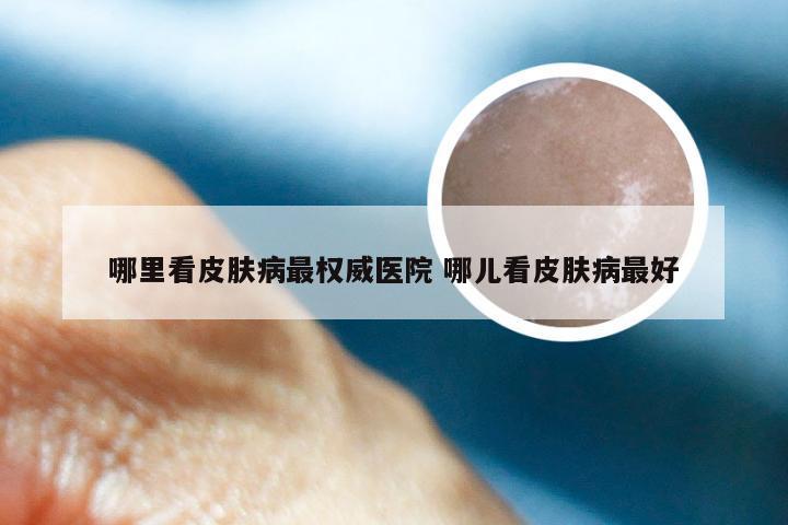 哪里看皮肤病最权威医院 哪儿看皮肤病最好