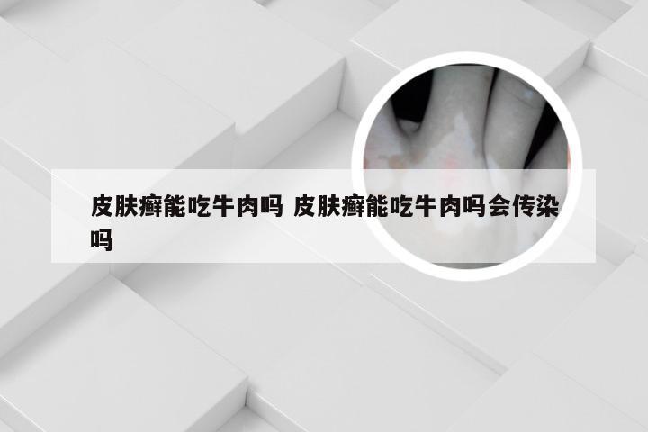 皮肤癣能吃牛肉吗 皮肤癣能吃牛肉吗会传染吗