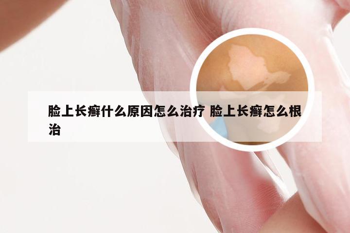 脸上长癣什么原因怎么治疗 脸上长癣怎么根治
