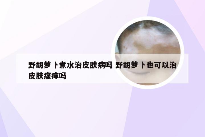 野胡萝卜煮水治皮肤病吗 野胡萝卜也可以治皮肤瘙痒吗