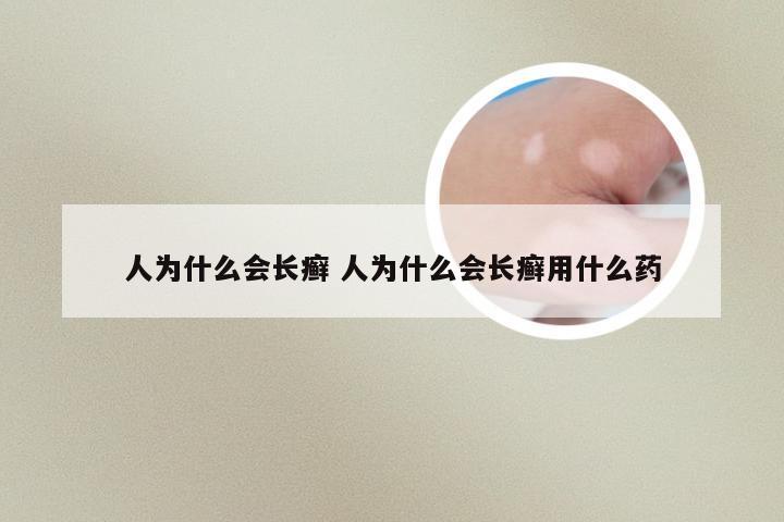 人为什么会长癣 人为什么会长癣用什么药