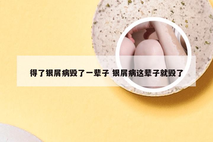 得了银屑病毁了一辈子 银屑病这辈子就毁了