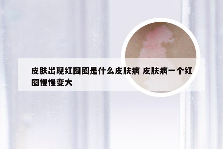 皮肤出现红圈圈是什么皮肤病 皮肤病一个红圈慢慢变大