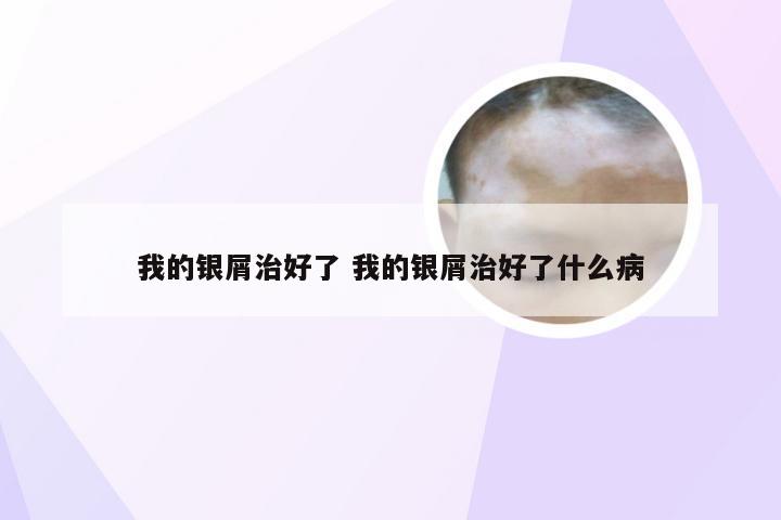 我的银屑治好了 我的银屑治好了什么病