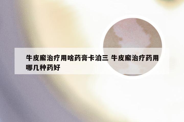 牛皮廨治疗用啥药膏卡泊三 牛皮廨治疗药用哪几种药好