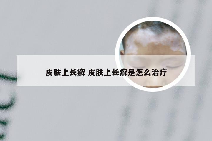 皮肤上长癣 皮肤上长癣是怎么治疗