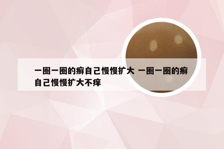 一圈一圈的癣自己慢慢扩大 一圈一圈的癣 自己慢慢扩大不痒