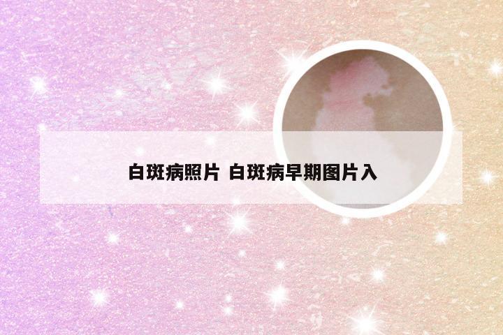 白斑病照片 白斑病早期图片入