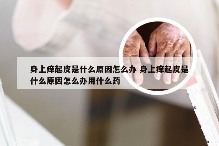 身上痒起皮是什么原因怎么办 身上痒起皮是什么原因怎么办用什么药
