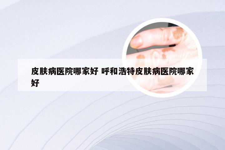 皮肤病医院哪家好 呼和浩特皮肤病医院哪家好