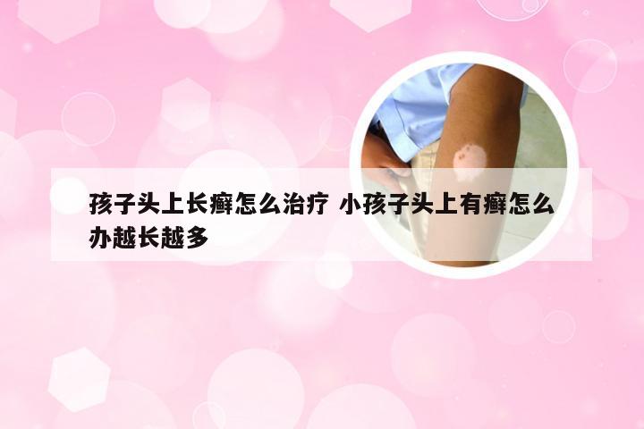 孩子头上长癣怎么治疗 小孩子头上有癣怎么办越长越多