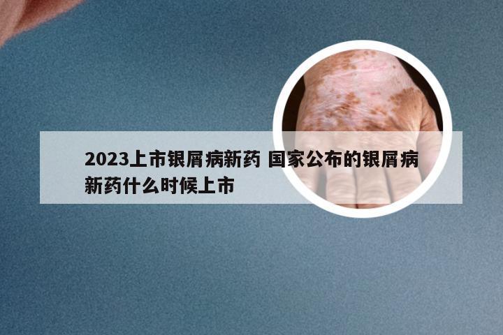 2023上市银屑病新药 国家公布的银屑病新药什么时候上市