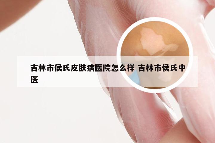 吉林市侯氏皮肤病医院怎么样 吉林市侯氏中医