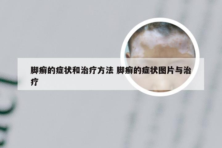 脚癣的症状和治疗方法 脚癣的症状图片与治疗
