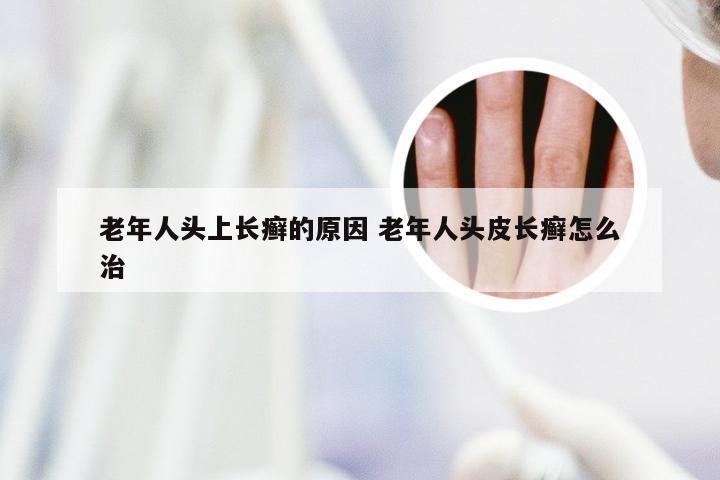 老年人头上长癣的原因 老年人头皮长癣怎么治