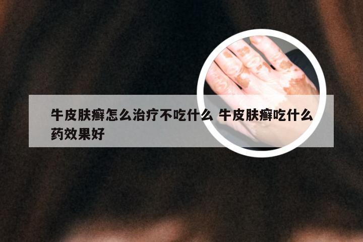 牛皮肤癣怎么治疗不吃什么 牛皮肤癣吃什么药效果好