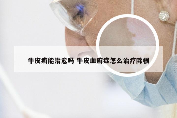 牛皮癣能治愈吗 牛皮血癣症怎么治疗除根